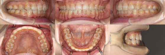 インビザライン症例画像3-2