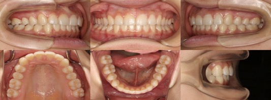 インビザライン症例画像2-2