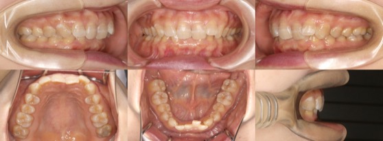 インビザライン症例画像3-1