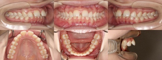 インビザライン症例画像2-1