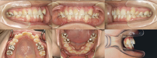 インビザライン症例画像1-1