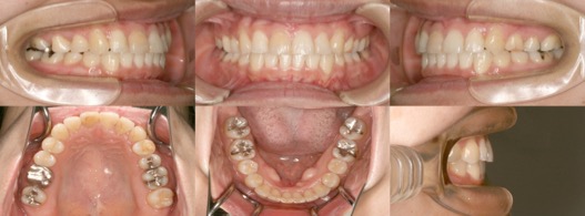 インビザライン症例画像1-2